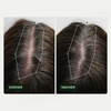 Vorher-Nachher-Vergleich des Haarwuchses einer Person vor und nach der Anwendung von Bio Plixin Serum+ Men von Scandinavian Biolabs; nachher etwas dichteres Haar.