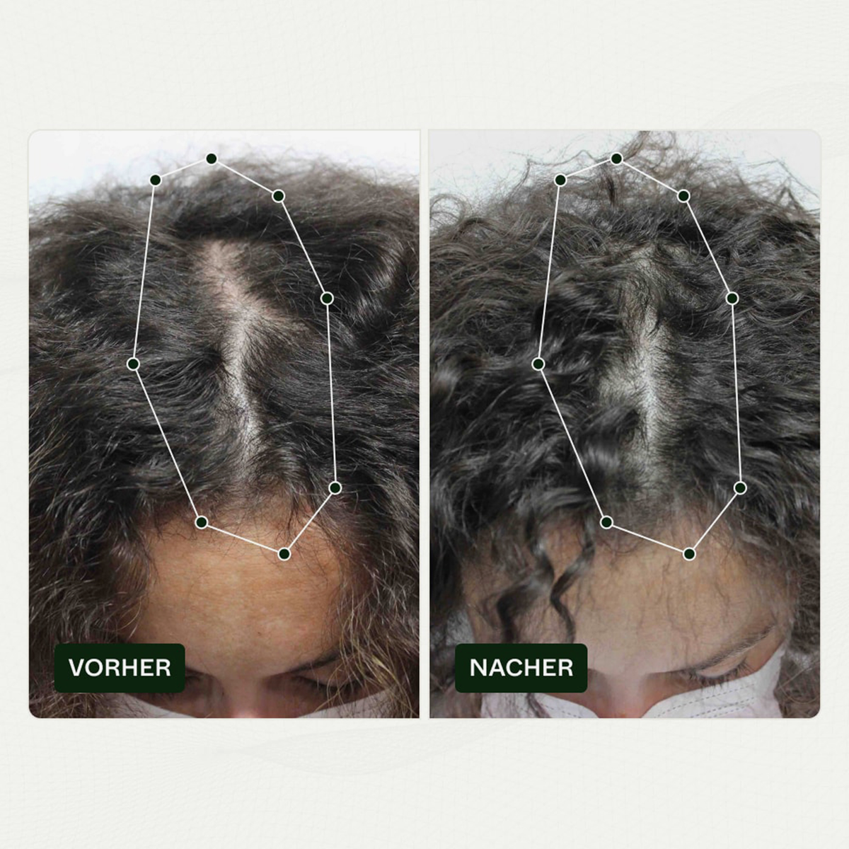 Vorher-Nachher-Bilder der Kopfhaut einer Frau zeigen weniger sichtbare Haarausdünnung nach der Anwendung von Bio-Pilixin® Serum+ Women von Scandinavian Biolabs.