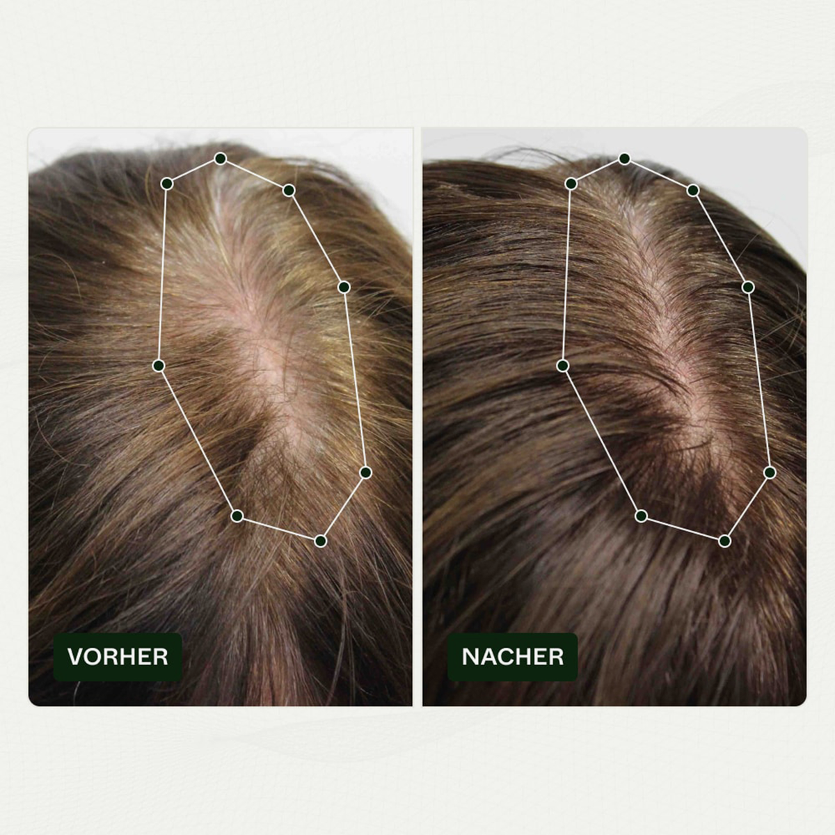 Vorher-Nachher-Vergleich des Haarwuchses einer Person vor und nach der Anwendung von Bio Plixin Serum+ Men von Scandinavian Biolabs; nachher etwas dichteres Haar.