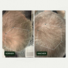 Vorher-Nachher-Vergleich des Haarwuchses einer Person vor und nach der Anwendung von Bio Plixin Serum+ Men von Scandinavian Biolabs; nachher etwas dichteres Haar.