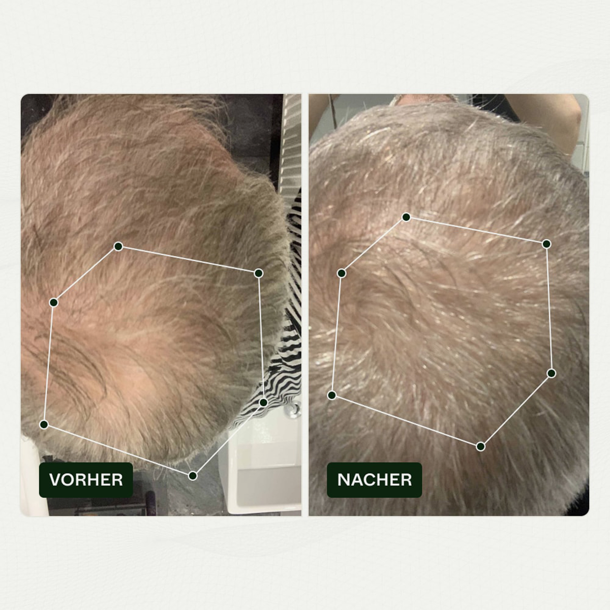 Vorher-Nachher-Vergleich des Haarwuchses einer Person vor und nach der Anwendung von Bio Plixin Serum+ Men von Scandinavian Biolabs; nachher etwas dichteres Haar.