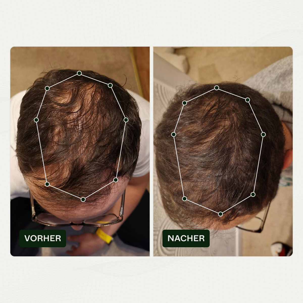 Vorher-Nachher-Vergleich des Haarwuchses einer Person vor und nach der Anwendung von Bio Plixin Serum+ Men von Scandinavian Biolabs; nachher etwas dichteres Haar.
