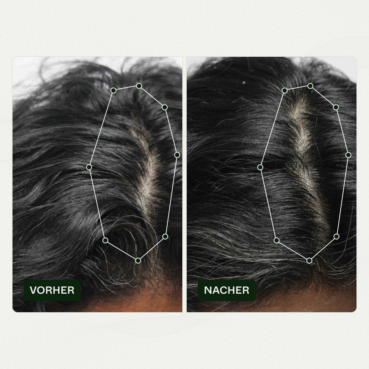 Vorher-Nachher-Bilder der Kopfhaut einer Frau zeigen weniger sichtbare Haarausdünnung nach der Anwendung von Bio-Pilixin® Serum+ Women von Scandinavian Biolabs.