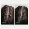 Vorher-Nachher-Bilder der Kopfhaut einer Frau zeigen weniger sichtbare Haarausdünnung nach der Anwendung von Bio-Pilixin® Serum+ Women von Scandinavian Biolabs.
