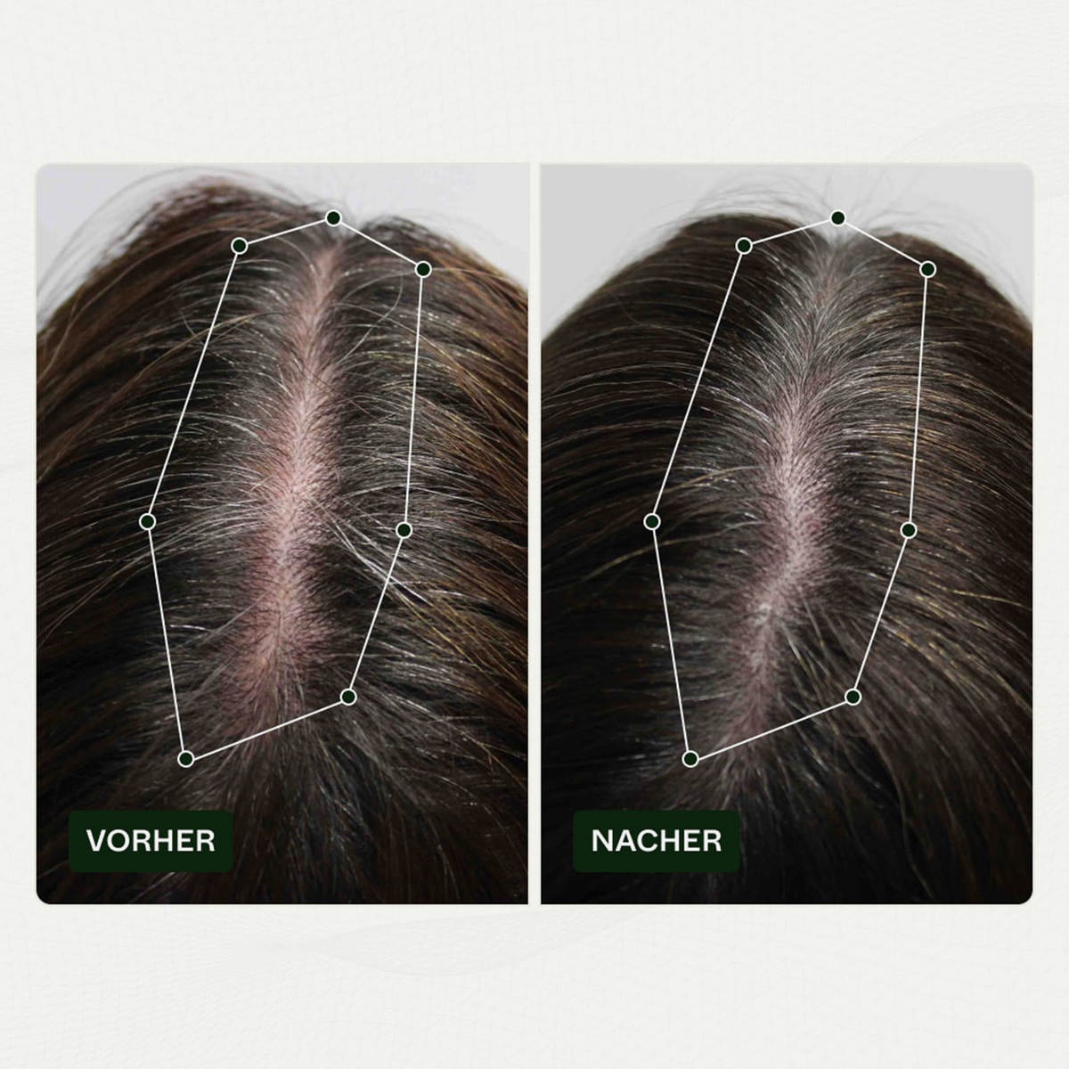 Vorher-Nachher-Bilder der Kopfhaut einer Frau zeigen weniger sichtbare Haarausdünnung nach der Anwendung von Bio-Pilixin® Serum+ Women von Scandinavian Biolabs.