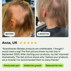 Seitenansicht des Kopfes einer Frau, die nach 5-monatiger Anwendung von Bio-Pilixin® Serum+ Women von Scandinavian Biolabs das Nachwachsen der Haare im Vergleich zur ursprünglichen kahlen Stelle zeigt.