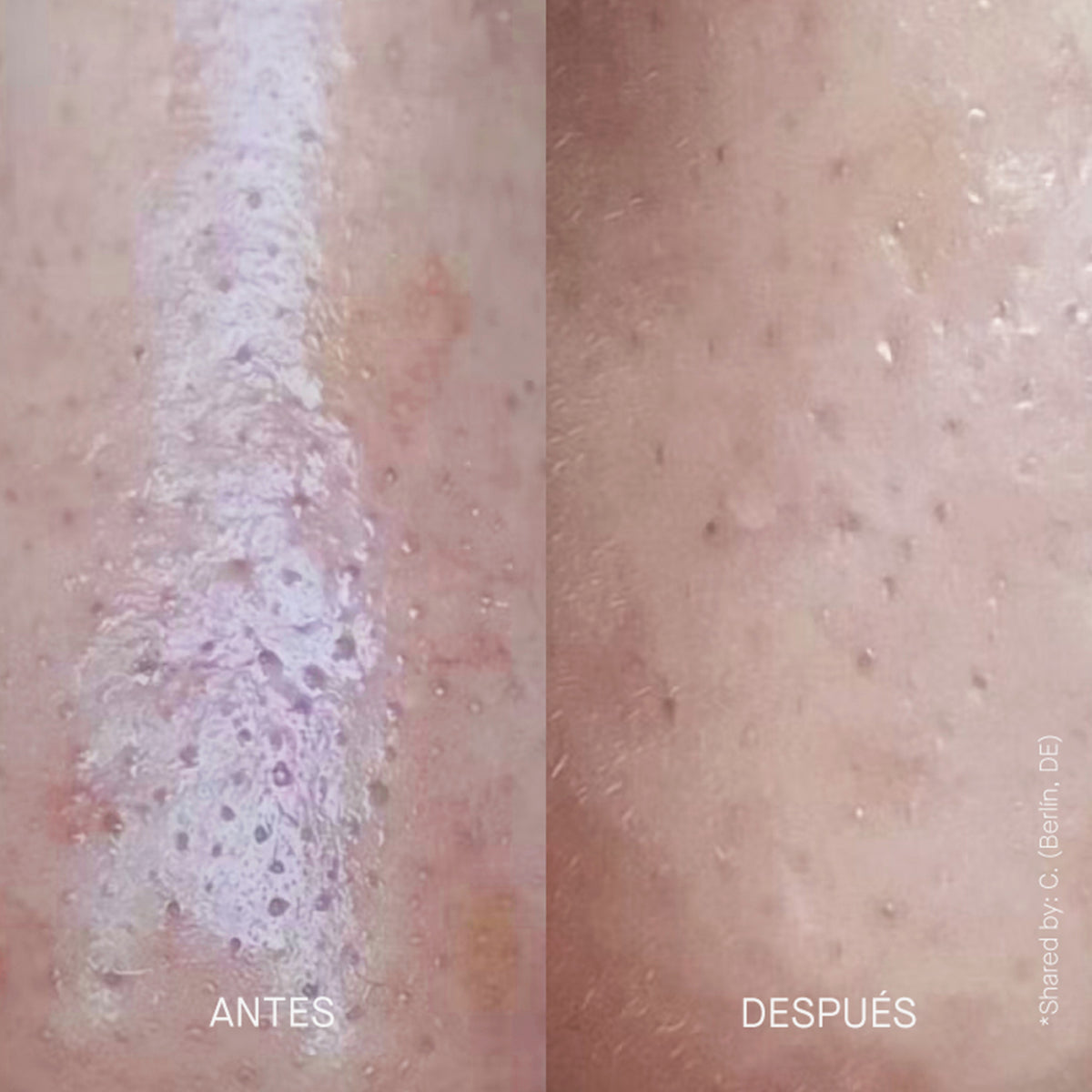 Vorher-Nachher-Bilder bei Anwendung von Zitproof Nose zeigen reduzierte Rötungen und eine glattere Hautstruktur.