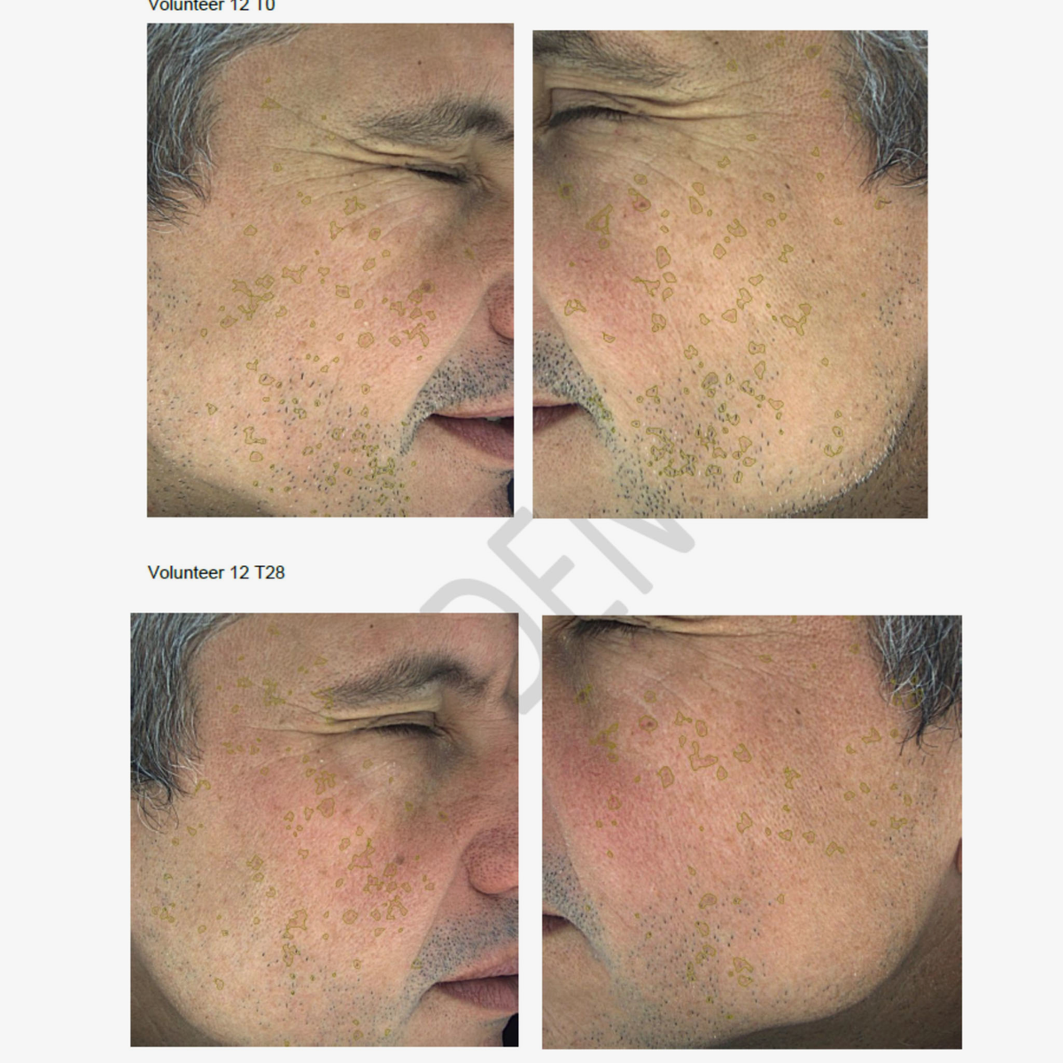 Seitliche Nahaufnahmen des Gesichts eines Mannes, die braune Flecken auf der Wange vor und nach der Behandlung mit NERDS. Hyperpigmentierung Serum.