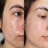 Nahaufnahme des Gesichts einer Frau, die die Vorher-Nachher-Ergebnisse mit der Barrier Restoring Hydrating Cream zeigt und die glattere, reinere Haut hervorhebt.